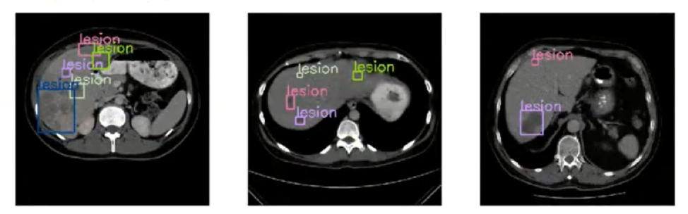 computer vision identifying tumors